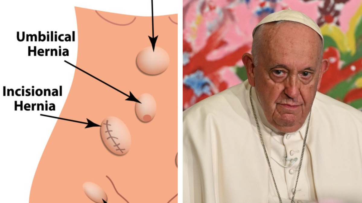 ¿Qué es una hernia incisional, razón por la que operaron al Papa Francisco?