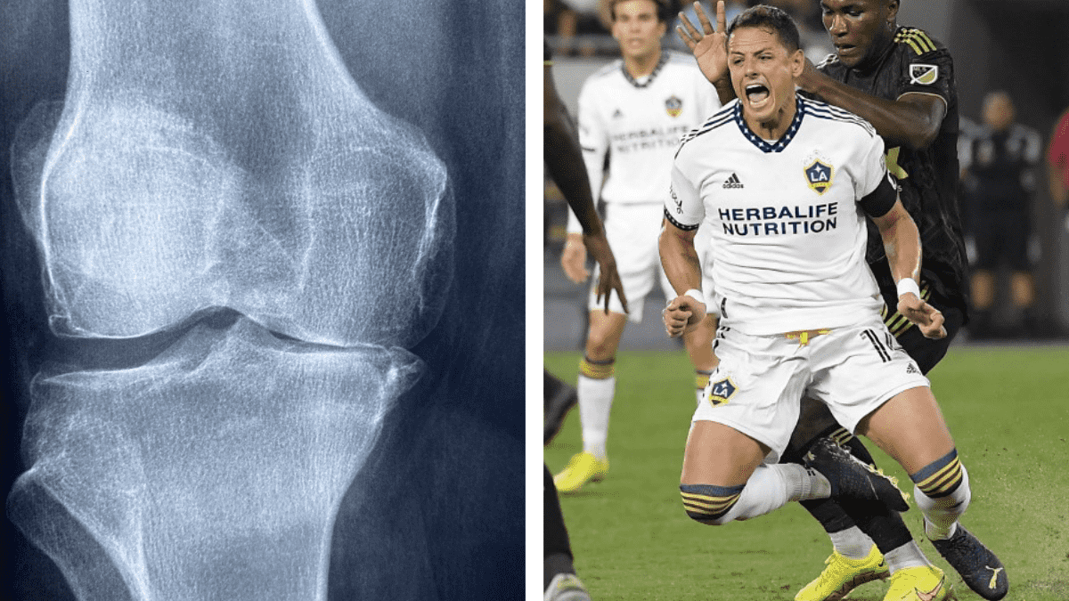 ¿Qué es la rotura de ligamento cruzado anterior, la lesión de “Chicharito” en la rodilla?