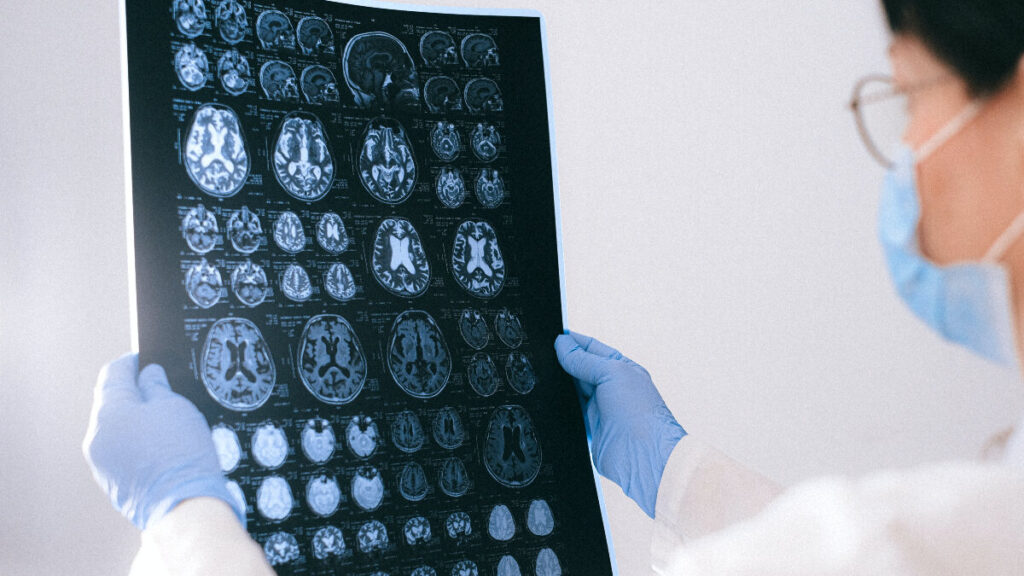 Enfermedades cerebrales o neurológicas pueden prevenirse al modificar factores de riesgo: Secretaría de Salud