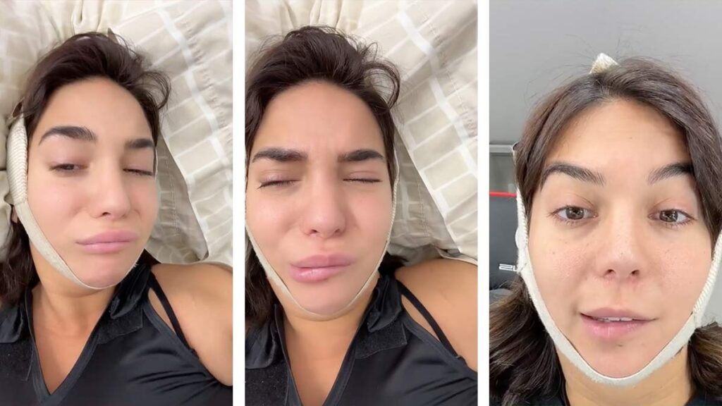 Influencer parálisis facial operación de papada