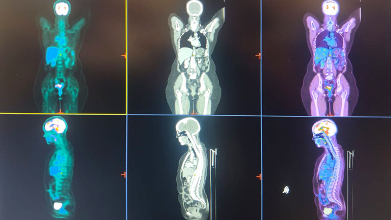 PET-CT: ¿cómo es el estudio que ayuda a diagnosticar el cáncer y otras ...