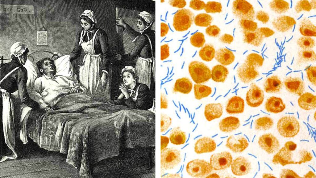 ¿Qué es la tuberculosis? Enfermedad de “moda” en el siglo XIX