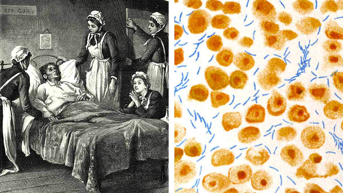 Tuberculosis, enfermedad que todos querían tener para alcanzar el estándar de belleza del siglo XIX