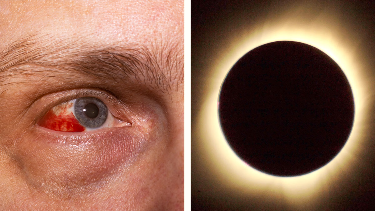Retinopatía solar: ¿qué es esta afección que puede causar ceguera por ver un eclipse sin protección?