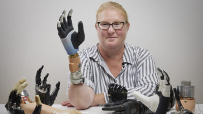 Una prótesis de mano biónica se fusiona con los sistemas nervioso y esquelético del usuario y permanece funcional después de años de uso diario.