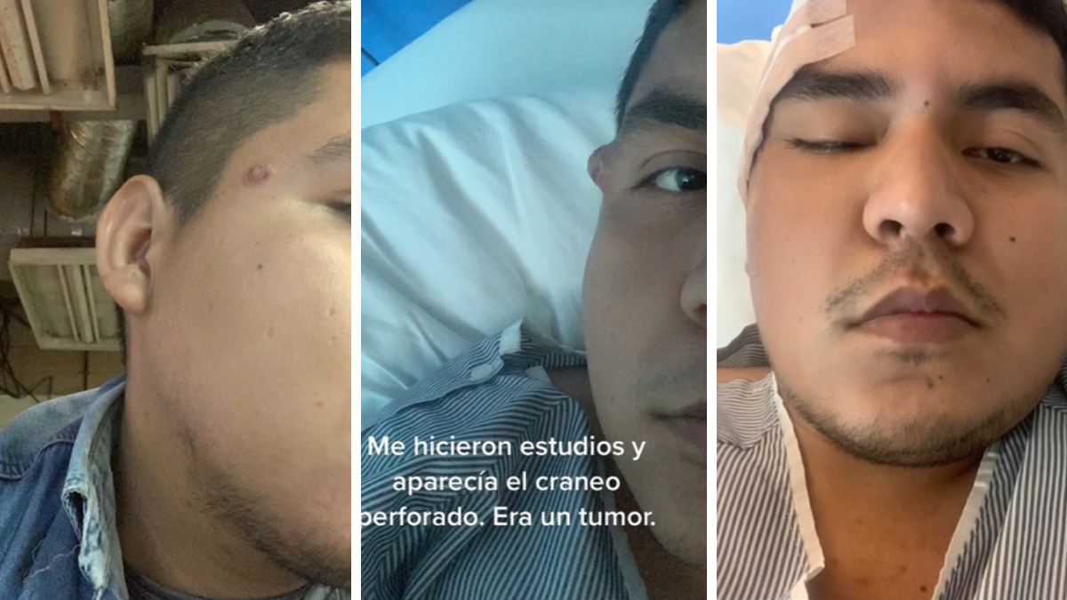 Empezó como un grano y terminó en un cáncer que le perforó el cráneo: joven mexicano comparte su historia