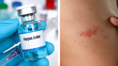 Herpes zóster: ¿qué es y dónde se consigue la vacuna contra la llamada culebrilla?