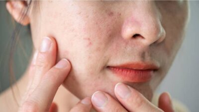 Cómo eliminar el acné: rutina de belleza para desaparecer granos. Foto: Getty Images