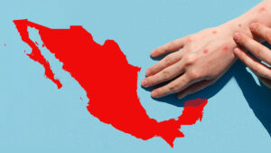 Confirman 12 muertes por sarampión en México, según SSA: “El brote está limitado a Chihuahua”