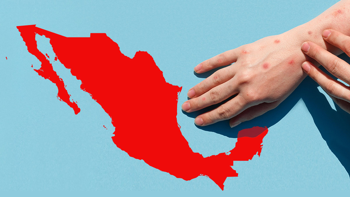 Alerta por sarampión: ¿podría regresar esta enfermedad a México?