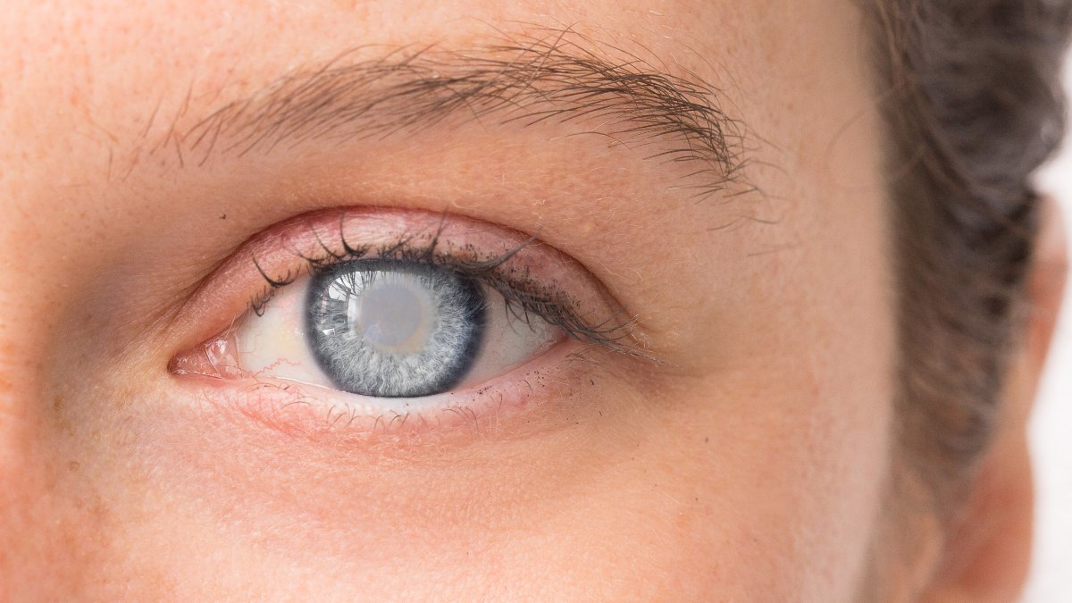 Médicos advierten del riesgo de glaucoma en jóvenes con miopía