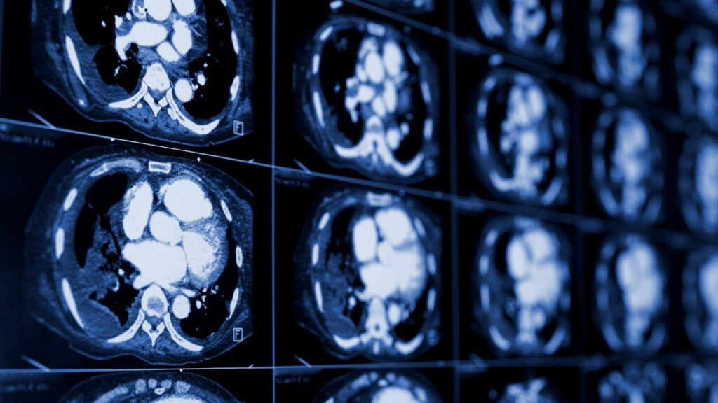 Hematoma Subdural