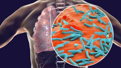 Repunta la tuberculosis: en 2023 alcanza la cifra de casos más alta en una década