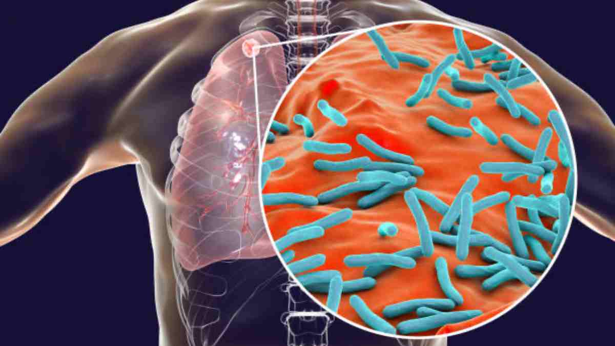 ¿Por qué están aumentando los casos de tuberculosis en el mundo? Síntomas y factores de riesgo