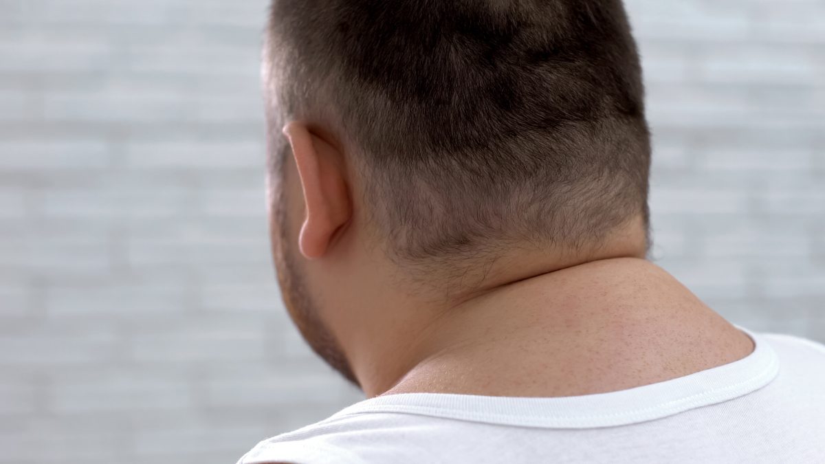 Joroba de búfalo: ¿es sólo grasa en tu cuello y espalda o esconde algo más?