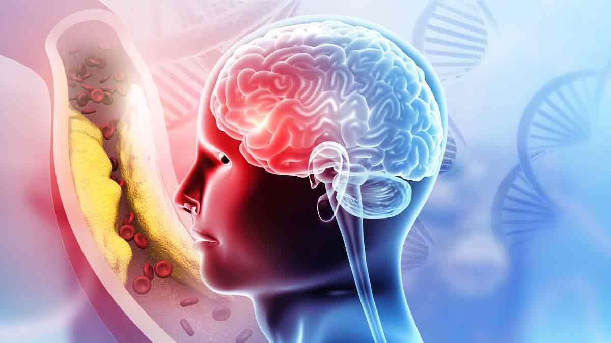 Microinfarto cerebral, ¿qué es, señales y por qué ocurre?