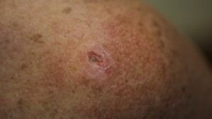 ¿Podría un lunar común convertirse en melanoma? Así suele verse un lunar canceroso