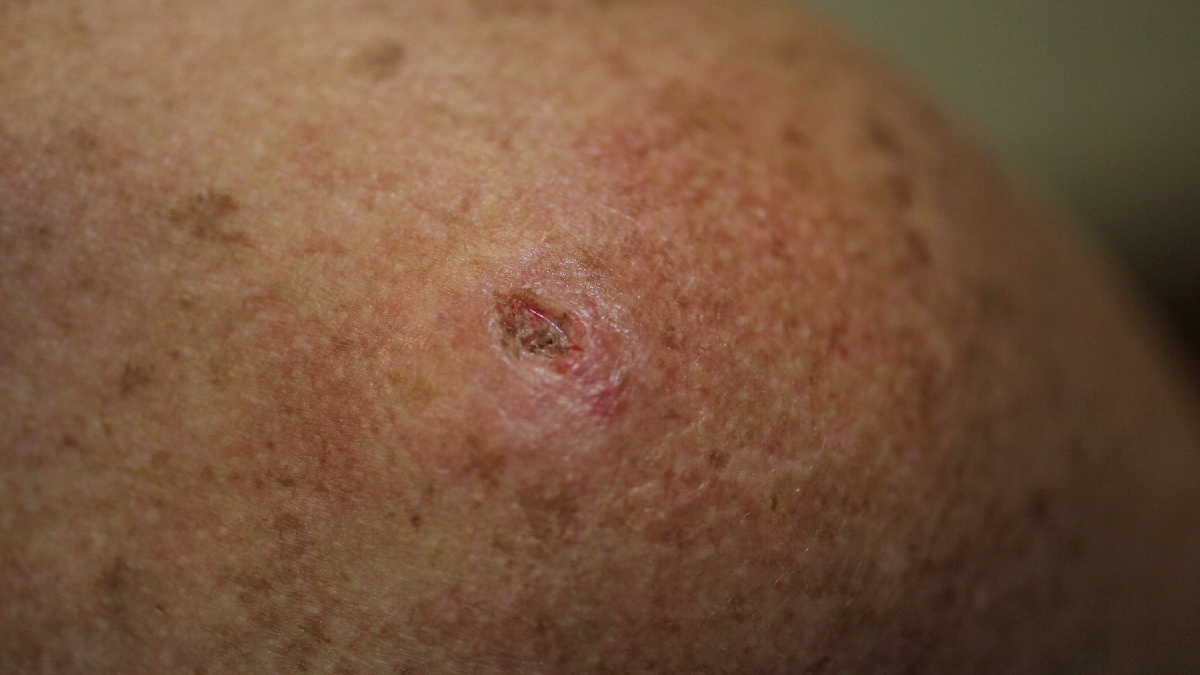 Detección tardía provoca 30% de muertes en pacientes con melanoma: Cómo identificar señales de alerta