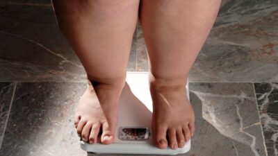¿Qué es el síndrome de Prader Willi, primera causa de obesidad de origen genético?