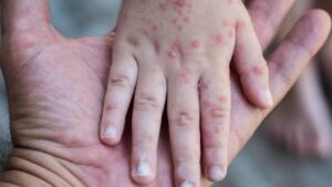 Suspenden clases en Baja California por brote del virus Coxsackie