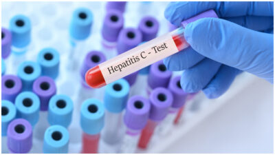 Prueba de hepatitis C en México: dónde se aplica gratis y señales de alerta de la enfermedad