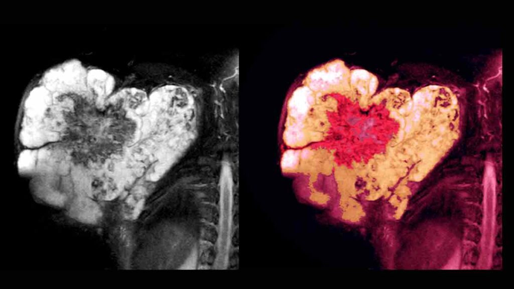 sarcoma