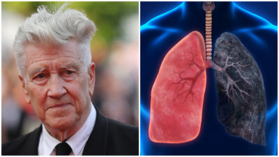 ¿Qué es el enfisema pulmonar, enfermedad que afecta a David Lynch?