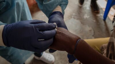 Mpox: África registra más de 18 mil 700 casos desde principios de 2024