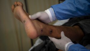 Hallan nueva cepa de viruela del mono más peligrosa en tres pacientes de Estados Unidos