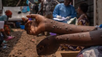 La OMS lanza un plan estratégico mundial de preparación y respuesta para contener el brote de mpox