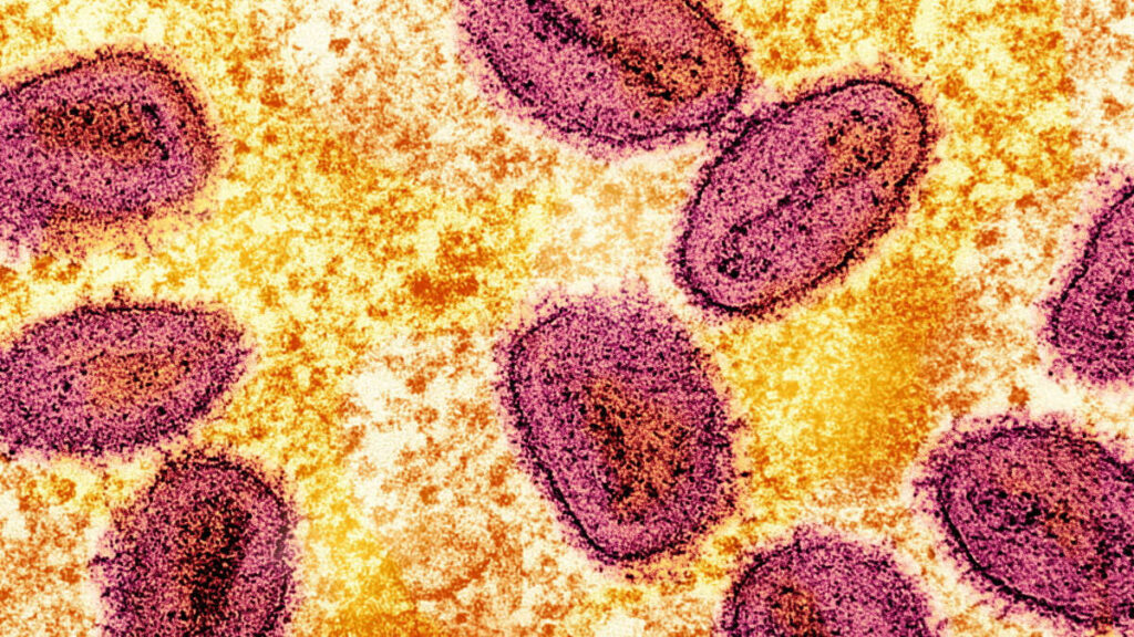 Detectan en Alemania nueva variante de la mpox