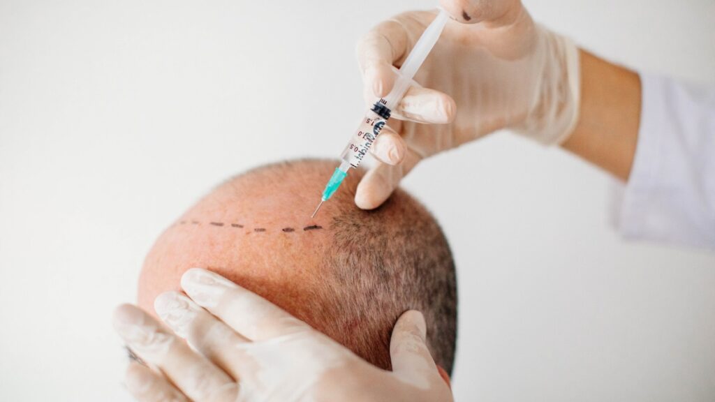 El influencer sufre los efectos de in implante de cabello. Getty Images