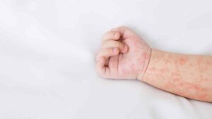 Alerta por sarampión en México: 4 mil 452 casos y 18 muertes, ve esquema de vacunación por brote