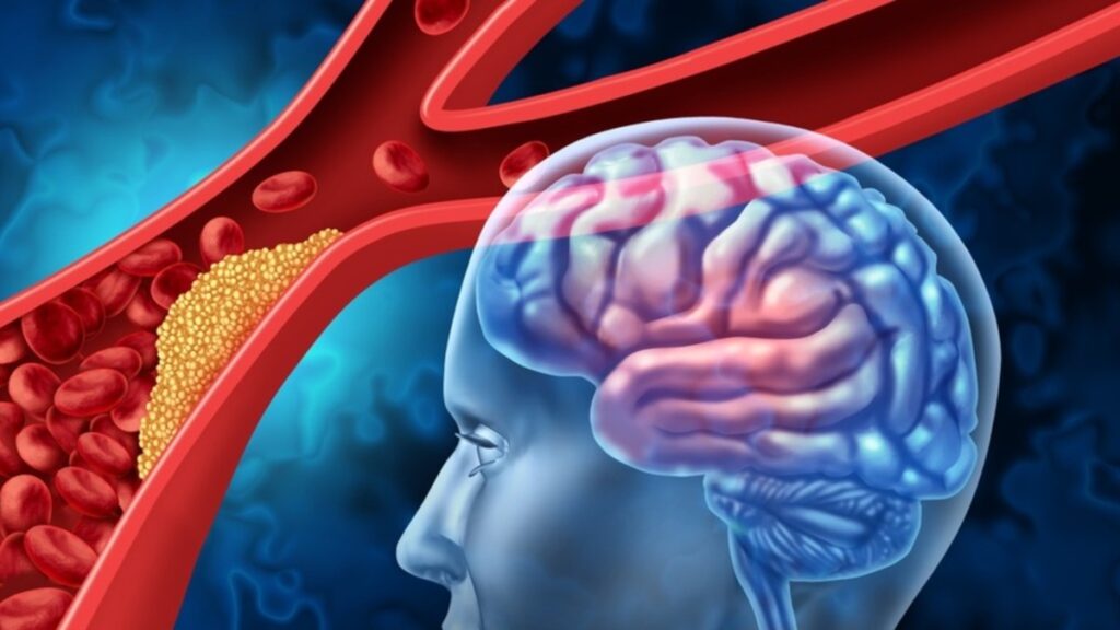 El Vaticano confirmó que el Papa Francisco falleció a causa de un ictus cerebral, descubre qué es este padecimiento.