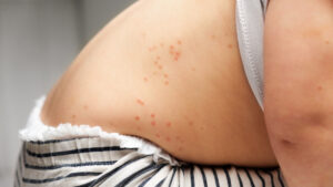 Suben a mil 520 los casos de sarampión en México: ¿cuáles son los estados más afectados?