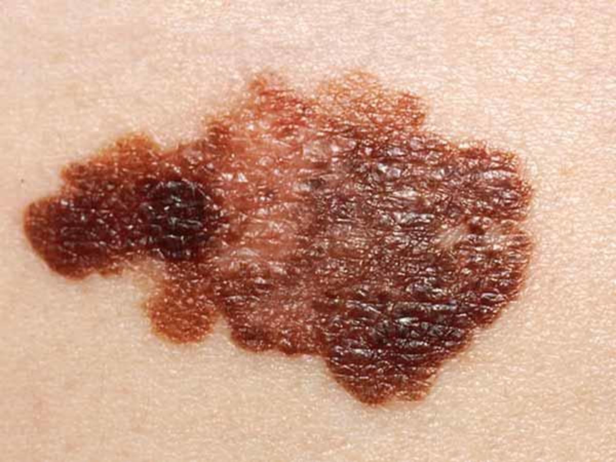 Melanoma 1