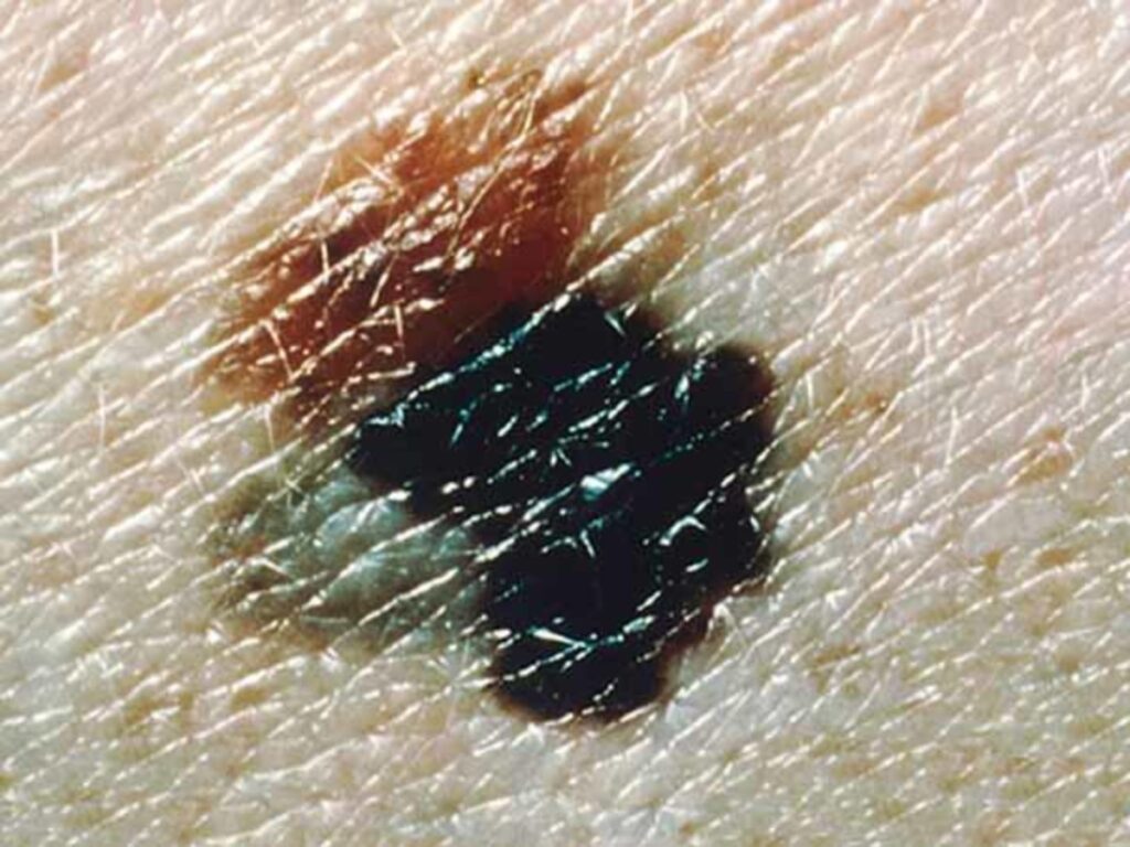 Melanoma disparejo. Crédito: Instituto Nacional de Cáncer en Estados Unidos.