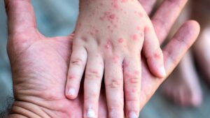 Niña muere por sarampión en Cajeme; ¿cuántos casos hay en Sonora?