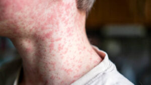 ¿Qué tan contagioso es el sarampión y cómo se propaga?