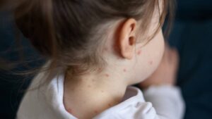 Confirman 3 casos de sarampión en BCS; implementan cerco epidemiológico en Comondú