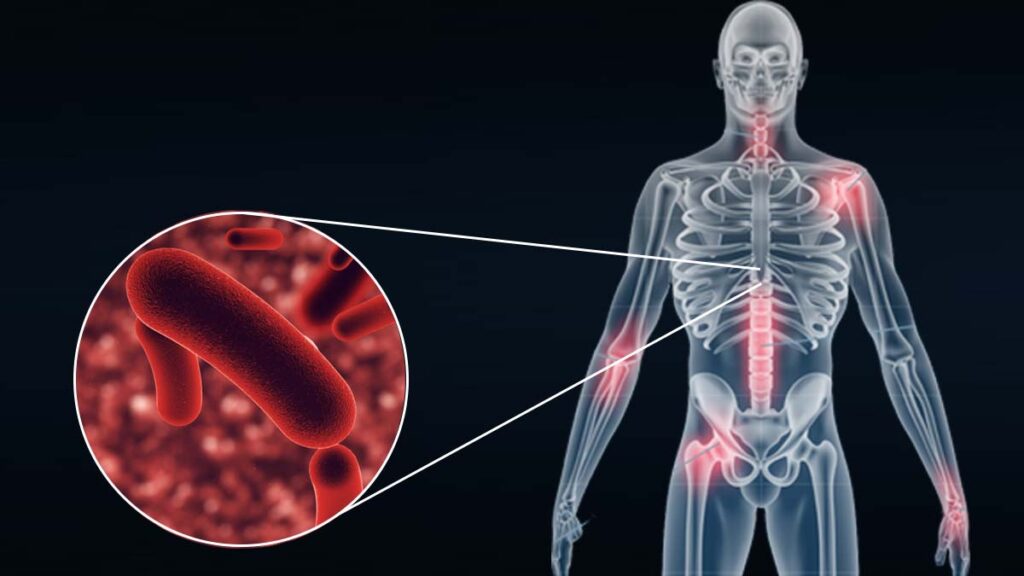 Tuberculosis