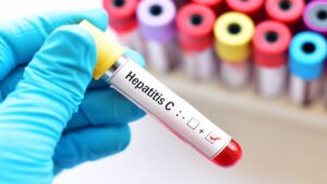 México en Top 5 mundial por muertes de cirrosis ligadas a hepatitis C: ¿cómo se contagia?