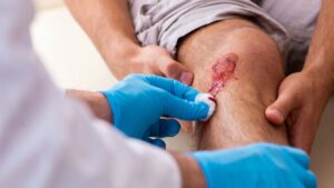 Primeros auxilios: ¿qué hacer si sufres una cortadura?