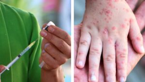 Sí hay vacunas contra sarampión; Sedesa aplica campaña intensiva en CDMX