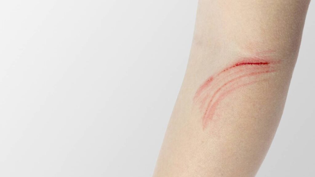 Secretaría de Salud Zacatecas anuncia caso probable de rabia en humano