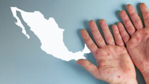 Suben a 467 los casos de viruela símica en México; CDMX concentra más de la mitad