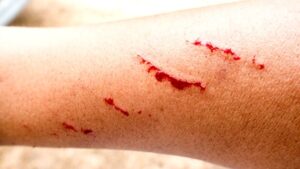 Muere en Zacatecas la adolescente infectada con rabia humana tras mordida de zorrillo