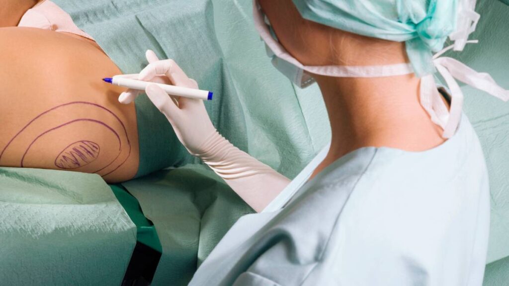 Liposucción que pagó a su esposa, terminó en ruptura de pareja.