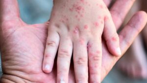 Analizan posible caso de sarampión en niño de 5 años en Arandas, Jalisco