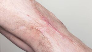 ¿Qué hacer ante quemaduras de primer, segundo y tercer grado?: “No toques el área lesionada”